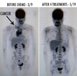 cancer